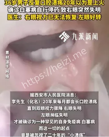 白塞病口腔溃疡识别